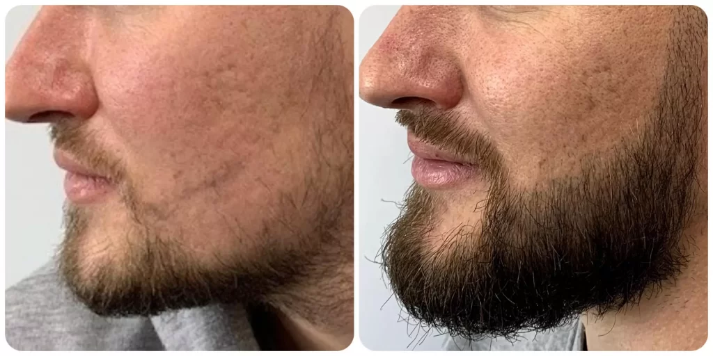 Minoxidil FTM